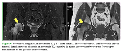 Resonancia magnética en secuencias T2 y T1, corte coronal. El sector subcondral periférico de la cabeza femoral derecha muestra alta señal en secuencia T2, sugestivo de edema óseo compatible con una fractura por insuficiencia en una paciente con osteopenia.