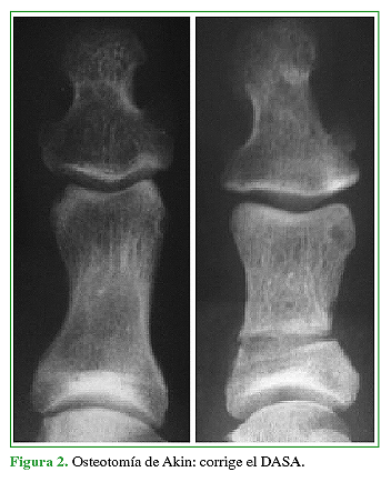 Osteotomía de Akin: corrige el DASA.