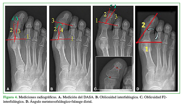 Mediciones radiográficas. A. Medición del DASA. B. Oblicuidad interfalángica. C. Oblicuidad F2-interfalángica. D. Ángulo metatarsofalángico-falange distal.