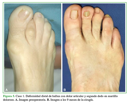 Caso 1. Deformidad distal de hallux con dolor articular y segundo dedo en martillo doloroso. A. Imagen preoperatoria. B. Imagen a los 9 meses de la cirugía.