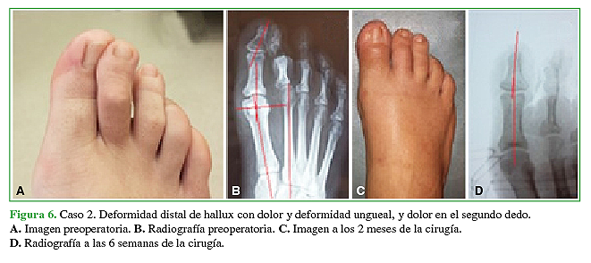 Caso 2. Deformidad distal de hallux con dolor y deformidad ungueal, y dolor en el segundo dedo. A. Imagen preoperatoria. B. Radiografía preoperatoria. C. Imagen a los 2 meses de la cirugía. D. Radiografía a las 6 semanas de la cirugía. 