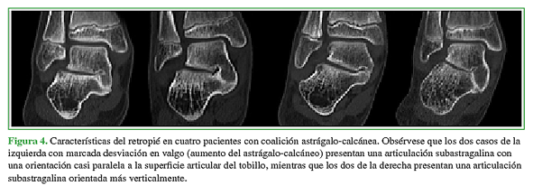 Características del retropié en cuatro pacientes con coalición astrágalo-calcánea. Obsérvese que los dos casos de la izquierda con marcada desviación en valgo (aumento del astrágalo-calcáneo) presentan una articulación subastragalina con una orientación casi paralela a la superficie articular del tobillo, mientras que los dos de la derecha presentan una artícula subastragalina orientada más verticalmente. 
