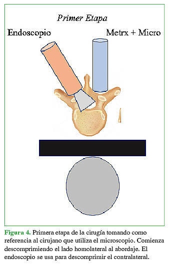 Primera etapa de la cirugía tomando como referencia al cirujano que utiliza el microscopio. Comienza descomprimiendo el lado homolateral al abordaje. El endoscopio se usa para descomprimir el contralateral.