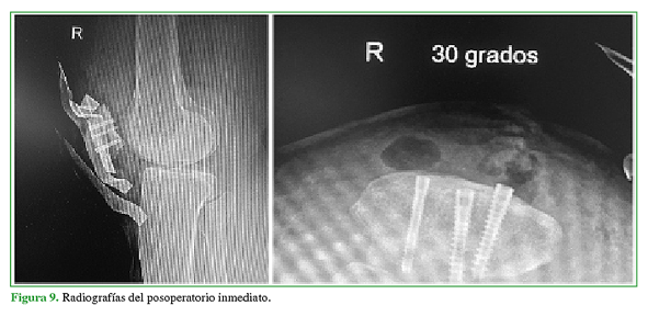Radiografías del posoperatorio inmediato.