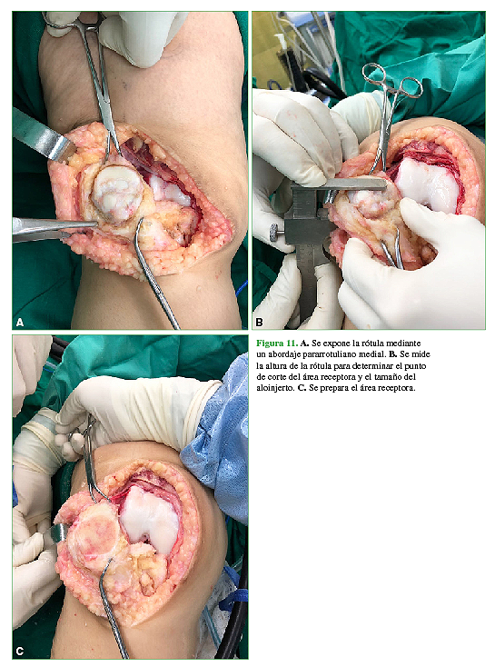 A. Se expone la rótula mediante un abordaje pararrotuliano medial. B. Se mide la altura de la rótula para determinar el punto de corte del área receptora y el tamaño del aloinjerto. C. Se prepara el área receptora.