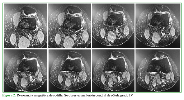 Resonancia magnética de rodilla. Se observa una lesión codral de rótula grado IV.