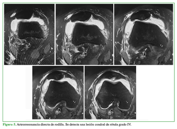 Artrorresonancia directa de rodilla. Se detecta una lesión condral de rótula grado IV.