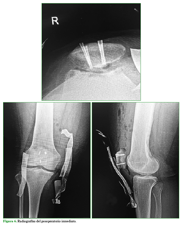 Radiografías del posoperatorio inmediato.