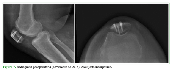 Radiografía posoperatoria (noviembre de 2018). Aloinjerto incorporado.