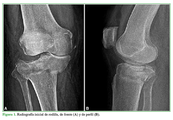 Radiografía inicial de rodilla, de frente (A) y de perfil (B).