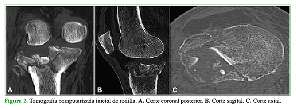 Tomografía computarizada inicial de rodilla. A. Corte coronal posterior. B. Corte sagital. C. Corte axial.