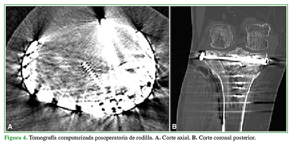 Tomografía computarizada posoperatoria de rodilla. A. Corte axial. B. Corte coronal posterior.