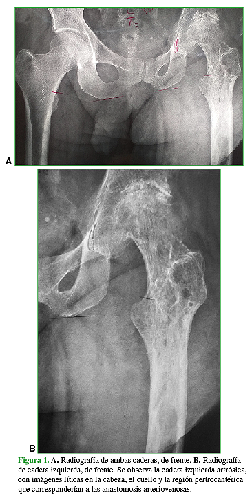 A. Radiografía de ambas caderas, de frente. B. Radiografía de cadera izquierda, de frente. Se observa la cadera izquierda artrósica, con imágenes líticas en la cabeza, el cuello y la región pertrocantérica que corresponderían a las anastomosis arteriovenosas. 