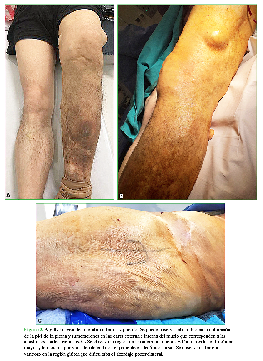 A y B. Imagen del miembro inferior izquierdo. Se puede observar el cambio en la coloración de la piel de la pierna y tumoraciones en las caras externa e interna del muslo que corresponden a las anastomosis arteriovenosas. C. Se observa la región de la cadera por operar. Están marcados el trocánter mayor y la incisión por vía anterolateral con el paciente en decúbito dorsal. Se observa un terreno varicoso en la región glútea que dificultaba el abordaje posterolateral. 