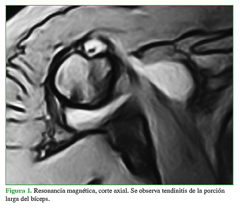 Resonancia magnética, corte axial. Se observa tendinitis de la porción larga del bíceps.