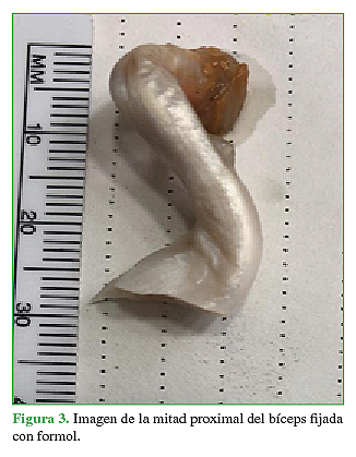 Imagen de la mitad proximal del bíceps fijada con formol.