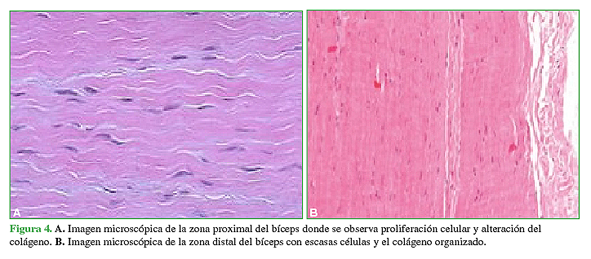 A. Imagen microscópica de la zona proximal del bíceps donde se observa proliferación celular y alteración del colágeno. B. Imagen microscópica de la zona distal del bíceps con escasas células y el colágeno organizado.