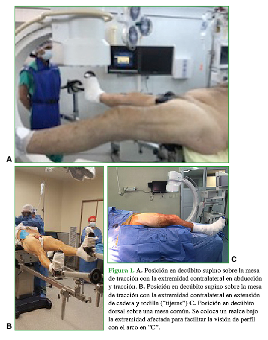 A. Posición en decúbito supino sobre la mesa de tracción con la extremidad contralateral en abducción y tracción. B. Posición en decúbito supino sobre la mesa de tracción con la extremidad contralateral en extensión de cadera y rodilla ("tijeras") C. Posición en decúbito dorsal sobre una mesa común. Se coloca un realce bajo la extremidad afectada para facilitar la visión de perfil con el arco en "C". 