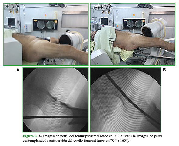 A. Imagen de perfil del fémur proximal (arco en "C" a 180º) B. Imagen de perfil contemplado la anteversión del cuello femoral (arco en "C" a 160º). 