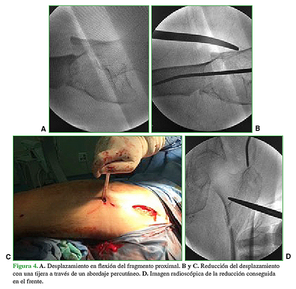 A. Desplazamiento en flexión del fragmento proximal. B y C. Reducción del desplazamiento con una tijera a través de un abordaje percutáneo. D. Imagen radioscópica de la reducción conseguida en el frente.  