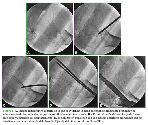 A. Imagen radioscópica de perfil en la que se evidencia la caída posterior del fragmento proximal y el solapamiento de las corticales, lo que imposibilita la reducción cerrada. B y C. Introducción de una clavija de 3 mm en el foco y reducción del desplazamiento. D. Estabilización transitoria con dos clavijas anteriores procurando que no interfieran con la introducción del calvo. E. Fijación definitiva con el tornillo cefálico. 
