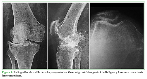 Radiografías de rodilla derecha preoperatorias. Genu valgo artrósico grado 4 de Kellgren y Lawrence con artrosis femororrotuliana.