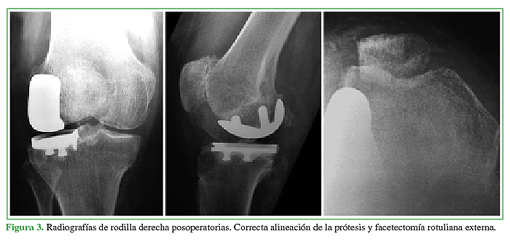 Radiografías de rodilla derecha posoperatorias. Correcta alineación de la prótesis y facetectomía rotuliana externa