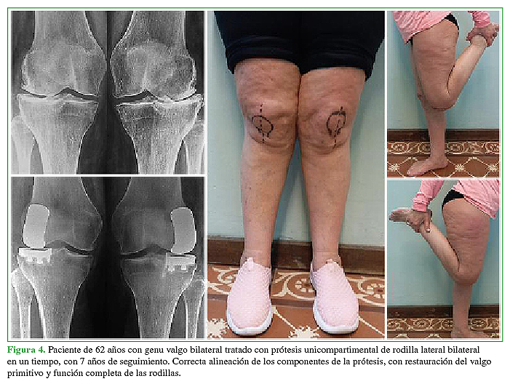 Paciente de 62 años con genu valgo bilateral tratado con prótesis unicompartimental de rodilla lateral bilateral en un tiempo, con 7 años de seguimiento. Correcta alineación de los componentes de la prótesis, con restauración del valgo primitivo y función completa de las rodillas. 