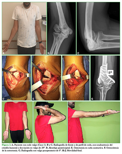 A. Paciente con codo valgo (Caso 1). B y C. Radiografía de frente y de perfil de codo, con seudoartrosis del cóndilo humeral y desviación en valgo de 29º. D. Abordaje paratricipital. E. Osteotomía en cuña sustractiva. F. Osteosíntesis de la osteotomía. G. Radiografía con valgo posoperatorio de 8º. H-J. Movilidad final.  