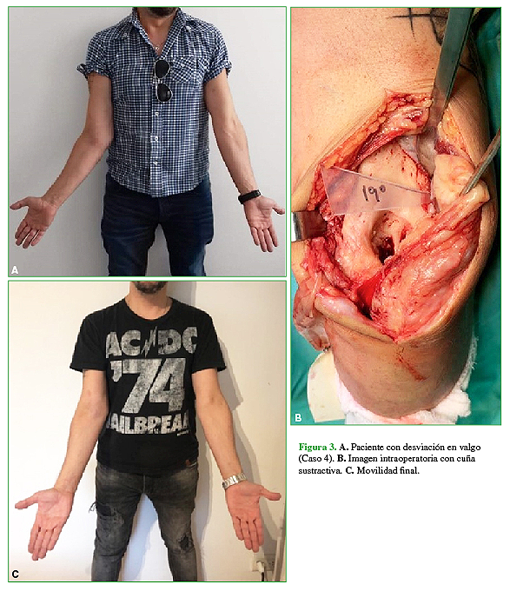A. Paciente con desviación en valgo (Caso 4). B. Imagen intraoperatoria con cuña sustractiva. C. Movilidad final. 