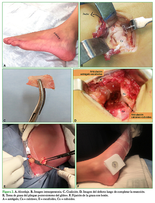 A. Abordaje. B. Imagen intraoperatoria. C. Coalición. D. Imagen del defecto luego de completar la resección. E. Toma de grasa del pliegue posterointerno del glúteo. F. Fijación de la grasa con botón. A = astrágalo, Ca = calcáneo, E = escafoides, Cu = cuboides. 