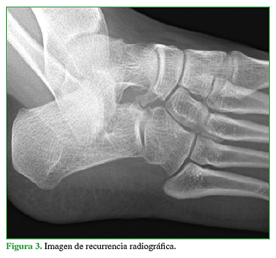 Imagen de recurrencia radiográfica.