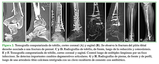 Tomografía computarizada de tobillo, cortes coronal (A) y sagital (B). Se observa la fractura del pilón tibial derecho asociada a una fractura de peroné. C y D. Radiografías de tobillo, de frente, luego de la reducción y osteosíntesis. E y F. Tomografía computarizada de tobillo, cortes coronal y sagital. Control luego de múltiples limpiezas por un foco infeccioso. Se detectan importantes cambios degenerativos articulares. G y H. Radiografías de pierna, de frente y de perfil, luego de una artrodesis tibio-calcánea retrógrada con un clavo recubierto de cemento con antibiótico.  