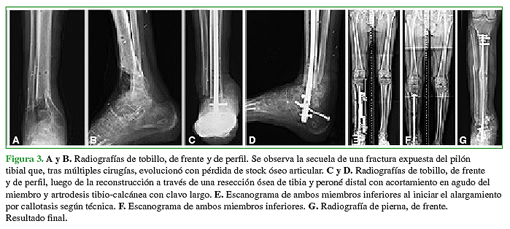 A y B. Radiografías de tobillo, de frente y de perfil. Se observa la secuela de una fractura expuesta del pilón tibial que, tras múltiples cirugías, evolucionó con pérdida de stock óseo articular. C y D. Radiografías tobillo, de frente y de perfil, luego de la reconstrucción a través de una resección ósea de tibia y peroné distal con acortamiento en agudo del miembro y artrodesis tibio-calcánea con clavo largo. E. Escanograma de ambos miembros inferiores al iniciar el alargamiento por callotasis según técnica. F. Escanograma de ambos miembros inferiores. G. Radiografía de pierna, de frente. Resultado final.  
