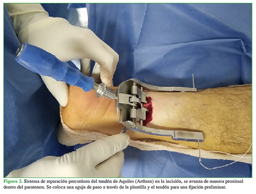 Sistema de reparación percutánea del tendón de Aquiles (Arthrex) en la incisión, se avanza de manera proximal dentro del paratenon.  Se coloca una aguja de paso a través de la plantilla y el tendón para una fijación preliminar 