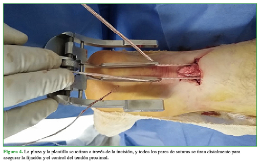 La pinza y la plantilla se retiran a través de la incisión, y todos los pares de suturas se tiran distalmente para asegurar la fijación y el control del tendón proximal 