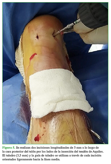 Se realizan dos incisiones longitudinales de 5 mm a lo largo de la cara posterior del talón por los lados de la inserción del tendón de Aquiles. El taladro (3,5 mm) y la guía de taladro se utilizan a través de cada incisión orientados ligeramente hacia la línea media 