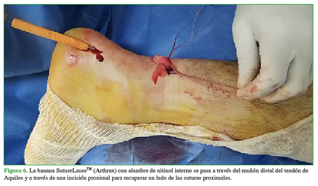 La banana SutureLasso™ (Arthrex) con alambre de nitinol interno se pasa a través del muñón distal del tendón de Aquiles y a través de una incisión proximal para recuperar un lado de las suturas proximales 