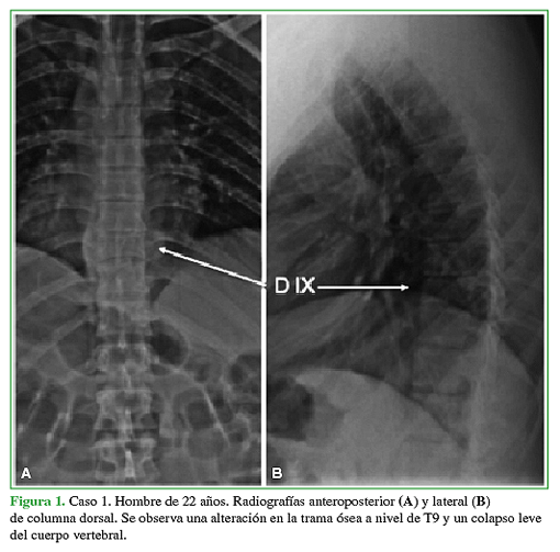 Caso 1. Hombre de 22 años. Radiografías anteroposterior (A) y lateral (B) de columna dorsal. Se observa una alteración en la trama ósea a nivel de T9 y un colapso leve del cuerpo vertebral. 