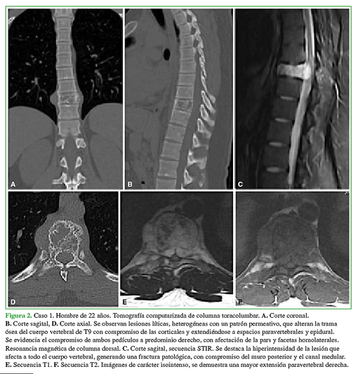 Caso 1. Hombre de 22 años. Tomografía computarizada de columna toracolumbar. A. Corte coronal. B. Corte sagital. D. Corte axial. Se observan lesiones líticas, heterogéneas con un patrón permeativo, que alteran la trama ósea del cuerpo vertebral de T9 con compromiso de las corticales y extendiéndose a espacios paravertebrales y epidural. Se evidencia el compromiso de ambos pedículos a predominio derecho, con afectación de la pars y facetas homolaterales. Resonancia magnética de columna dorsal. C. Corte sagital, secuencia STIR. Se destaca la hiperintensidad de la lesión que afecta a todo el cuerpo vertebral, generando una fractura patológica, con compromiso del muro posterior y el canal medular. E. Secuencia T1. F. Secuencia T2. Imágenes de carácter isointenso, se demuestra una mayor extensión paravertebral derecha.
