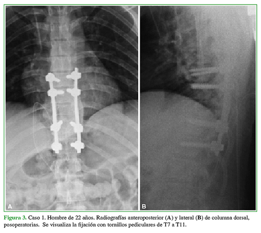 Caso 1. Hombre de 22 años. Radiografías anteroposterior (A) y lateral (B) de columna dorsal, posoperatorias. Se visualiza la fijación con tornillos pediculares de T7 a T11. 