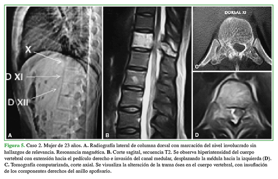 Caso 2. Mujer 23 años. A. Radiografía lateral de columna dorsal con marcación del nivel involucrado sin hallazgos de relevancia. Resonancia magnética. B. Corte sagital, secuencia T2. Se observa hiperintensidad del cuerpo vertebral con extensión hacia el pedículo derecho e invasión del canal medular, desplazando la médula hacia la izquierda (D). C. Tomografía computarizada, corte axial. Se visualiza la alteración de la trama ósea en el cuerpo vertebral, con insuflación de los componentes derechos del anillo apofisario.  