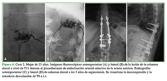 Caso 2. Mujer 23 años. Imágenes fluoroscópicas anteroposterior (A) y lateral (B) de la lesión de la columna dorsal a nivel T11 durante el procedimiento de embolización arterial selectiva de la arteria nutricia. Radiografías anteroposterior (C) y lateral (D) de columna dorsal a los 5 años de seguimiento. Se visualizan la descompresión y la artrodesis dorsolumbar de T9 a L1. 