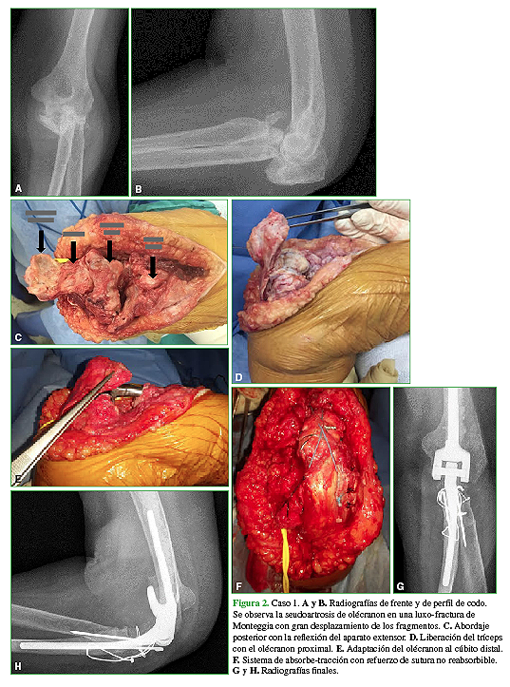 Caso 1. A y B. Radiografías de frente y de perfil de codo. Se observa la seudoartrosis de olécranon en una luxo-fractura de Monteggia con gran desplazamiento de los fragmentos. C. Abordaje posterior con la reflexión del aparato extensor. D. Liberación del tríceps con el olécranon proximal. E. Adaptación del olécranon al cúbito distal. F. Sistema de absorbe-tracción con refuerzo de sutura no reabsorbible. G y H. Radiografías finales. 