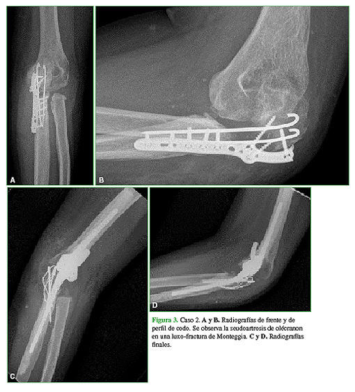 Caso 2. A y B. Radiografías de frente y de perfil de codo. Se observa la seudoartrosis de olécranon en una luxo-fractura de Monteggia. C y D. Radiografías finales.