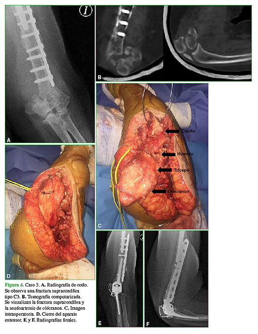 Caso 3. A. Radiografía de codo. Se observa una fractura supracondílea tipo C3. B. Tomografía computarizada. Se visualizan la fractura supracondílea y la seudoartrosis de olécranon. C. Imagen intraoperatoria. D. Cierre del aparato extensor. E y F. Radiografías finales.