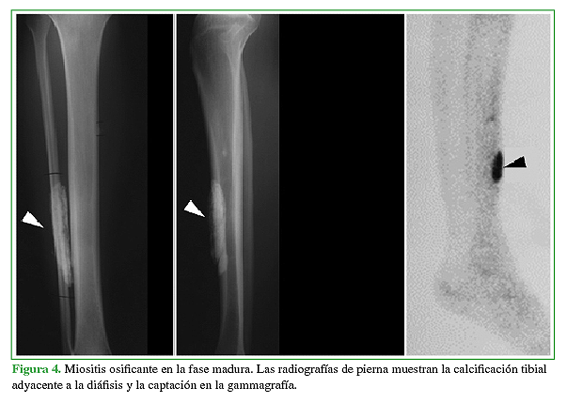 Miositis osificante en la fase madura. Las radiografías de pierna muestran la calcificación tibial adyacente a la diáfisis y la captación en la gammagrafía.