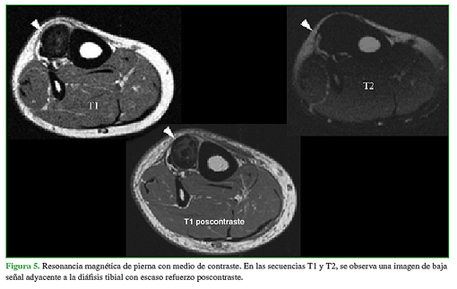 Resonancia magnética de pierna con medio contraste. En las secuencias T1 y T2, se observa una imagen de baja señal adyacente a la diáfisis tibial con escaso refuerzo poscontraste.