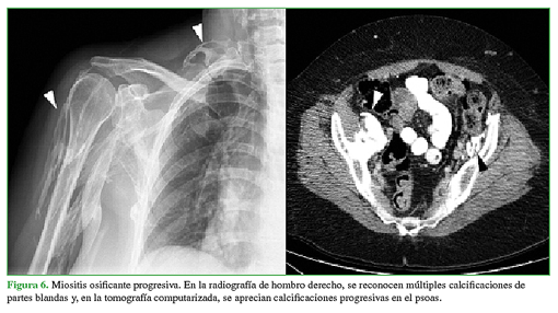 Miositis osificante progresiva. En la radiografía de hombro derecho, se reconocen múltiples calcificaciones de partes blandas y, en la tomografía computarizada, se aprecian calcificaciones progresivas en el psoas. 