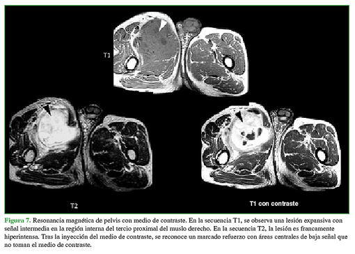 Resonancia magnética de pelvis con medio de contraste. En la secuencia T1, se observa una lesión expansiva con señal intermedia en la región interna del tercio proximal del muslo derecho. En la secuencia T2, la lesión es francamente hiperintensa. Tras la inyección del medio de contraste, se reconoce un marcado refuerzo con áreas centrales de baja señal que no toman el medio de contraste.